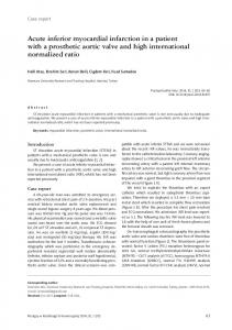 Acute inferior myocardial infarction in a patient with