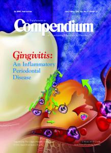 Gingivitis: Gingivitis