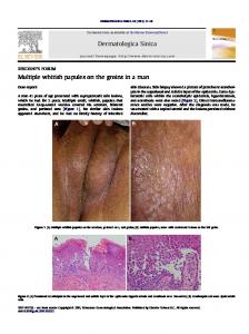 Multiple whitish papules on the groins in a man - Dermatologica Sinica