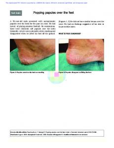 Popping papules over the feet