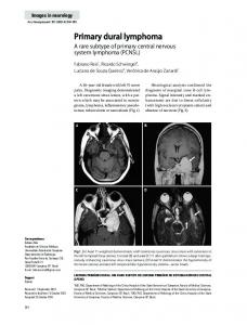 Primary dural lymphoma - SciELO