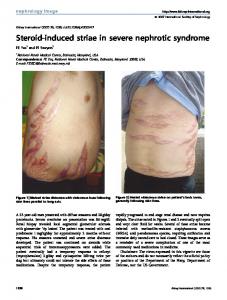 Steroid-induced striae in severe nephrotic syndrome